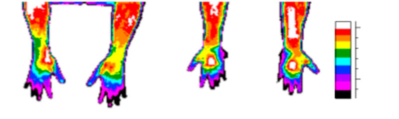 exame de termografia analisando temperatura dos braços